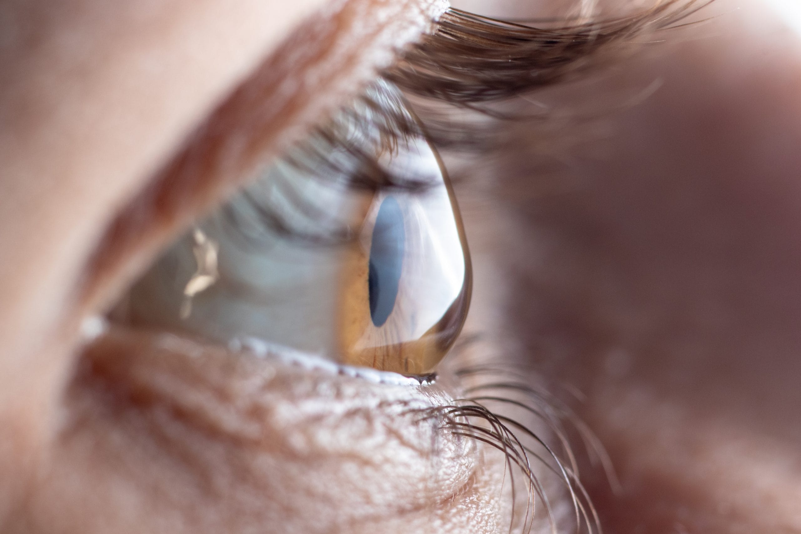 The cornea in the form of a cone, the disease of the eye keratoconus.